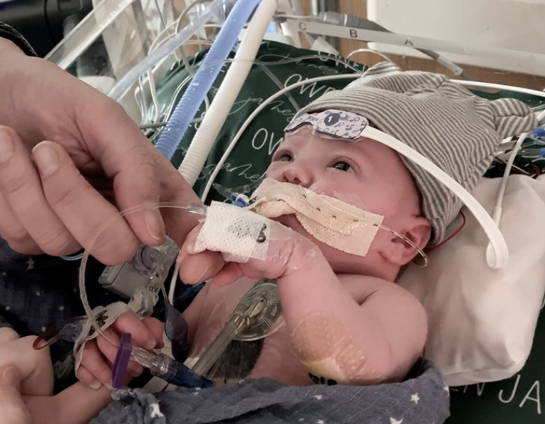 An infant, who was the world’s first partial heart transplant at Duke Health in the spring of 2022 and needed heart valve replacement, is pictured.