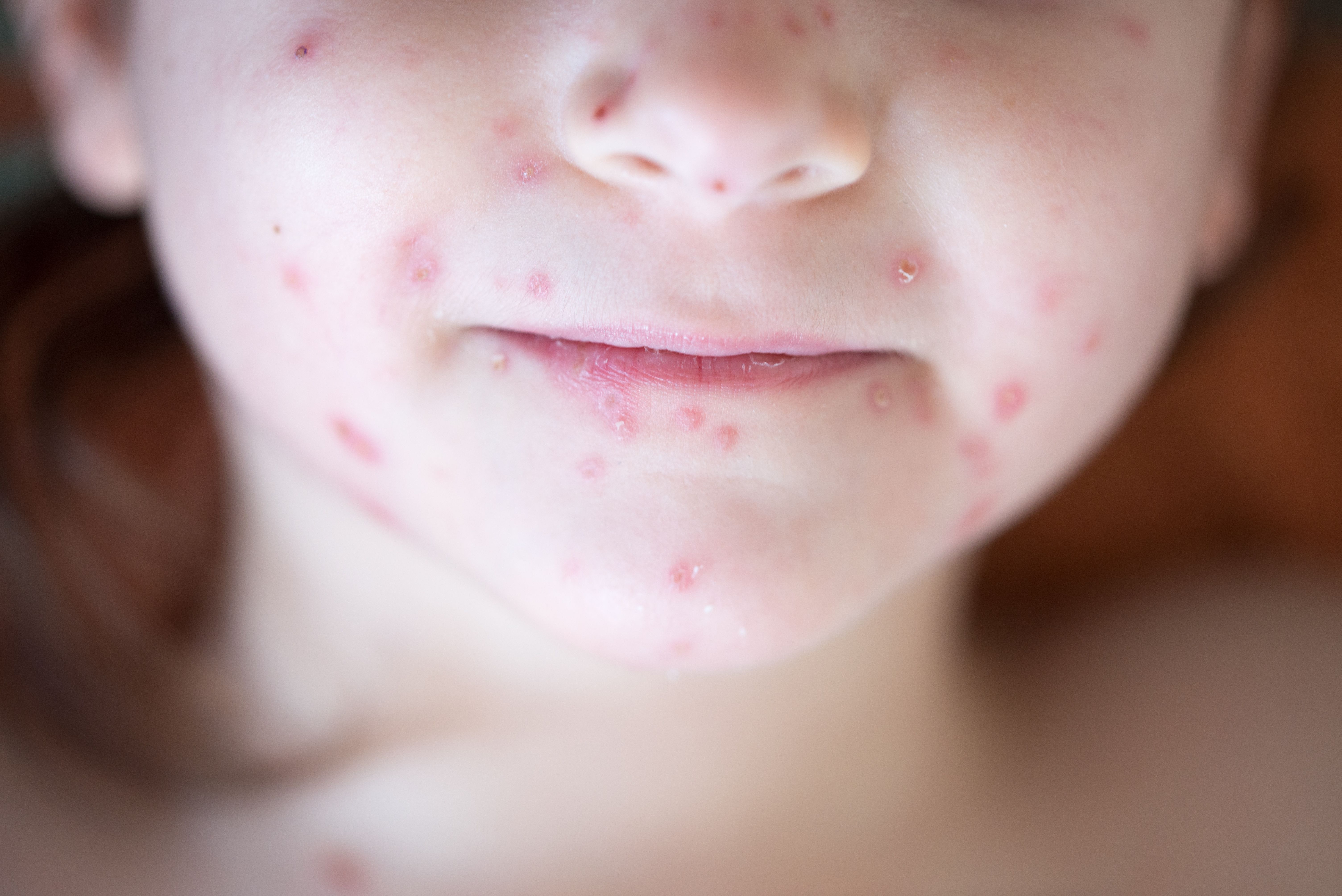 Measles outbreaks in Europe has put U.S. health officials on high alert for the infectious illness. Reports say most U.S. cases are linked to foreign travel.