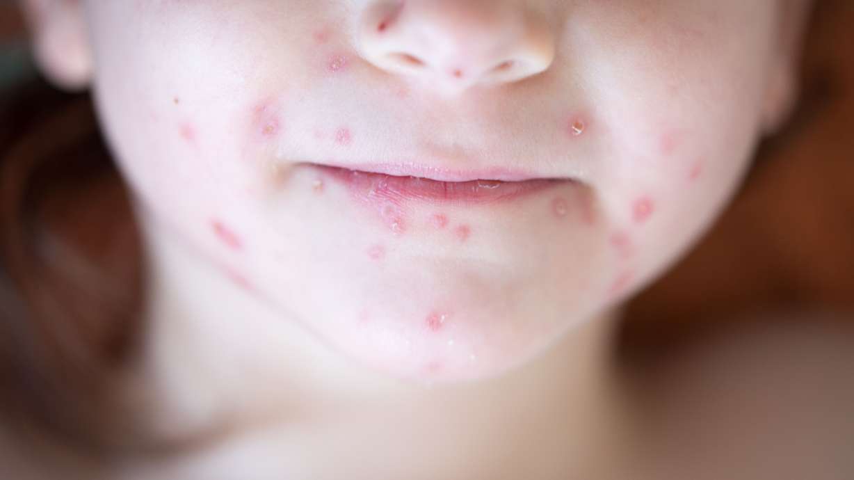 Measles outbreaks in Europe has put U.S. health officials on high alert for the infectious illness. Reports say most U.S. cases are linked to foreign travel.