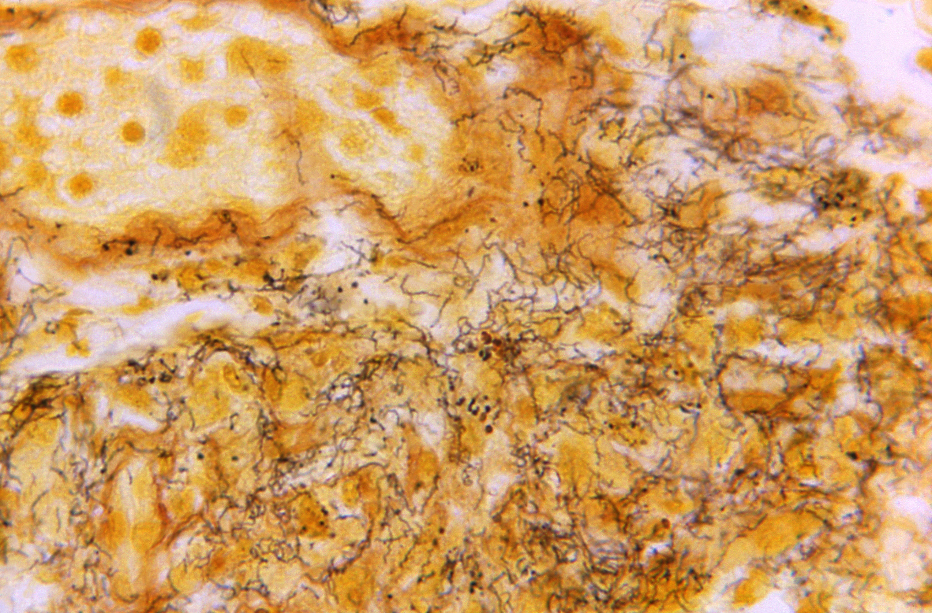 Microscope photo shows a tissue sample with the presence of numerous Treponema pallidum spirochetes, the bacterium responsible for causing syphilis. The U.S. syphilis epidemic continues to worsen, according to a new U.S. report. 