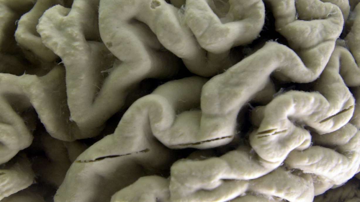 A closeup of a human brain affected by Alzheimer's disease at New York's Museum of Neuroanatomy. New research shows Alzheimer’s ravages the brain long before symptoms appear.