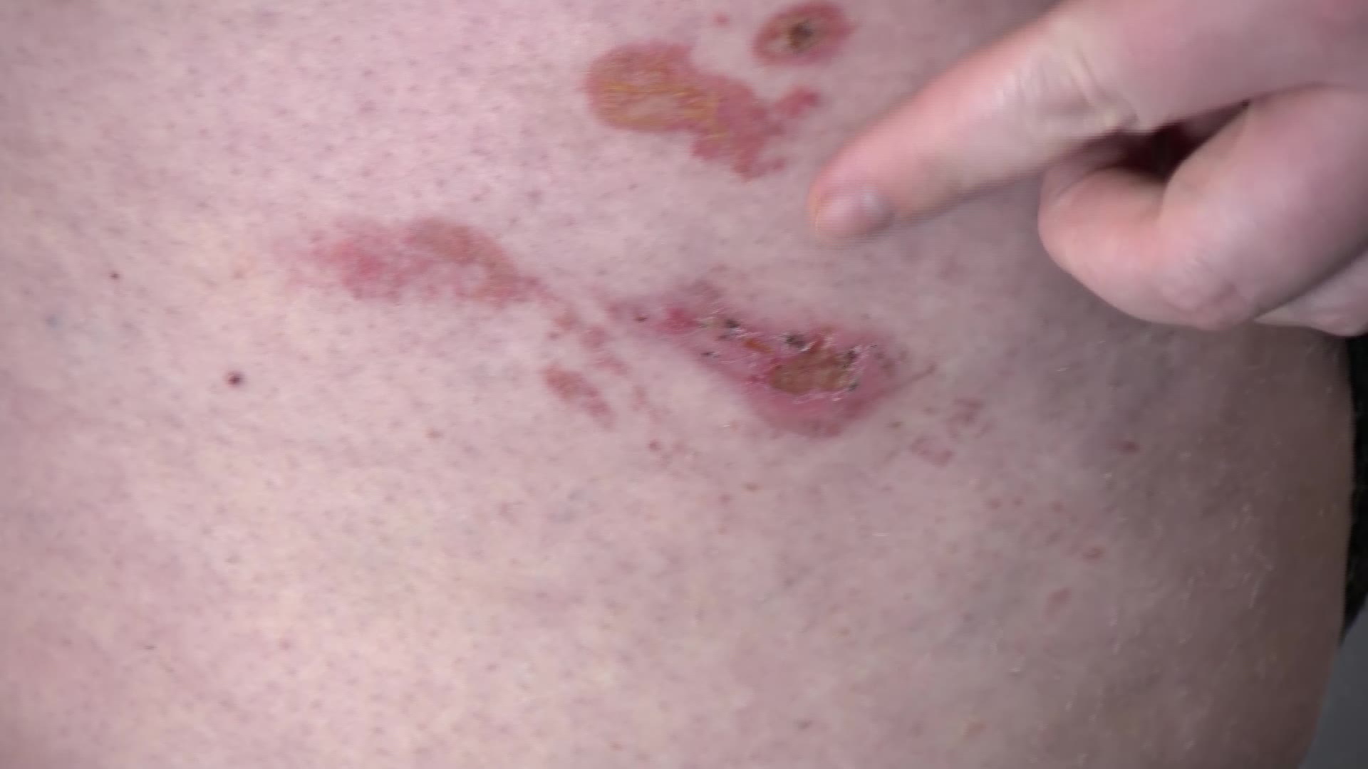 The burns on Christopher Kendall’s body after a battery explosion.