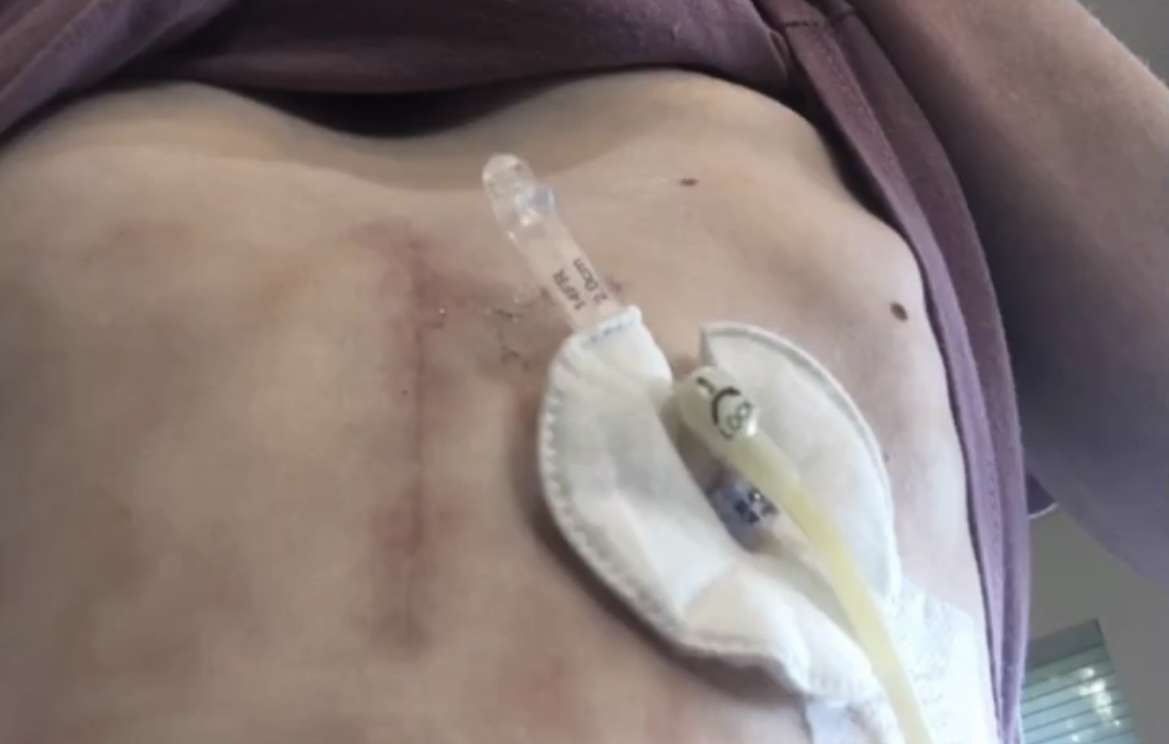 Gracelyn Wilkinson’s scarred stomach with hospital equipment attached.