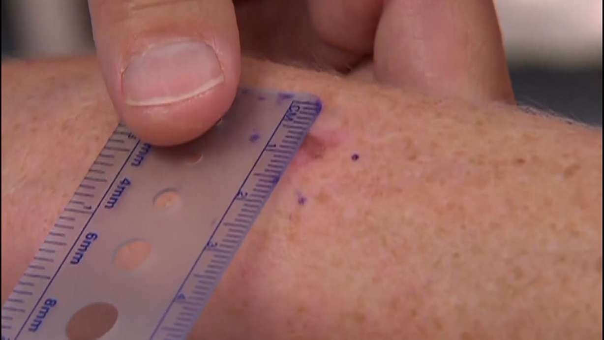 A person measuring a mole that could be cancerous.