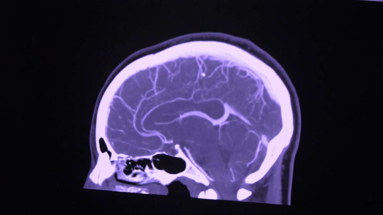A brain scan shows what a stroke looks like. Intermountain Health is working to increase the speed its smaller emergency rooms respond to strokes, because every minute counts.