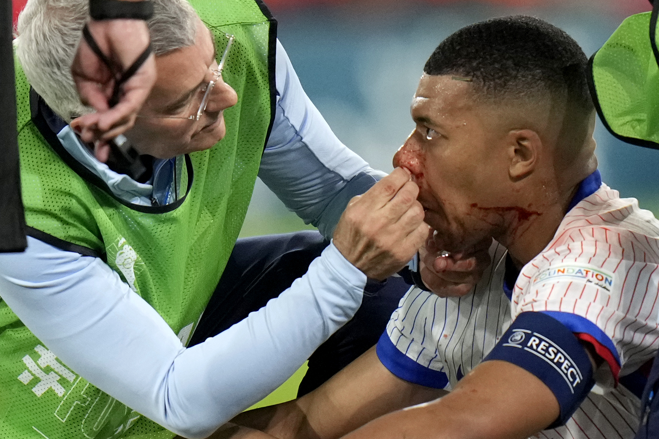Kylian Mbappe of France receives a treatment after suffering an injury during a Group D match between Austria and France at the Euro 2024 soccer tournament in Duesseldorf, Germany, Monday, June 17, 2024. 