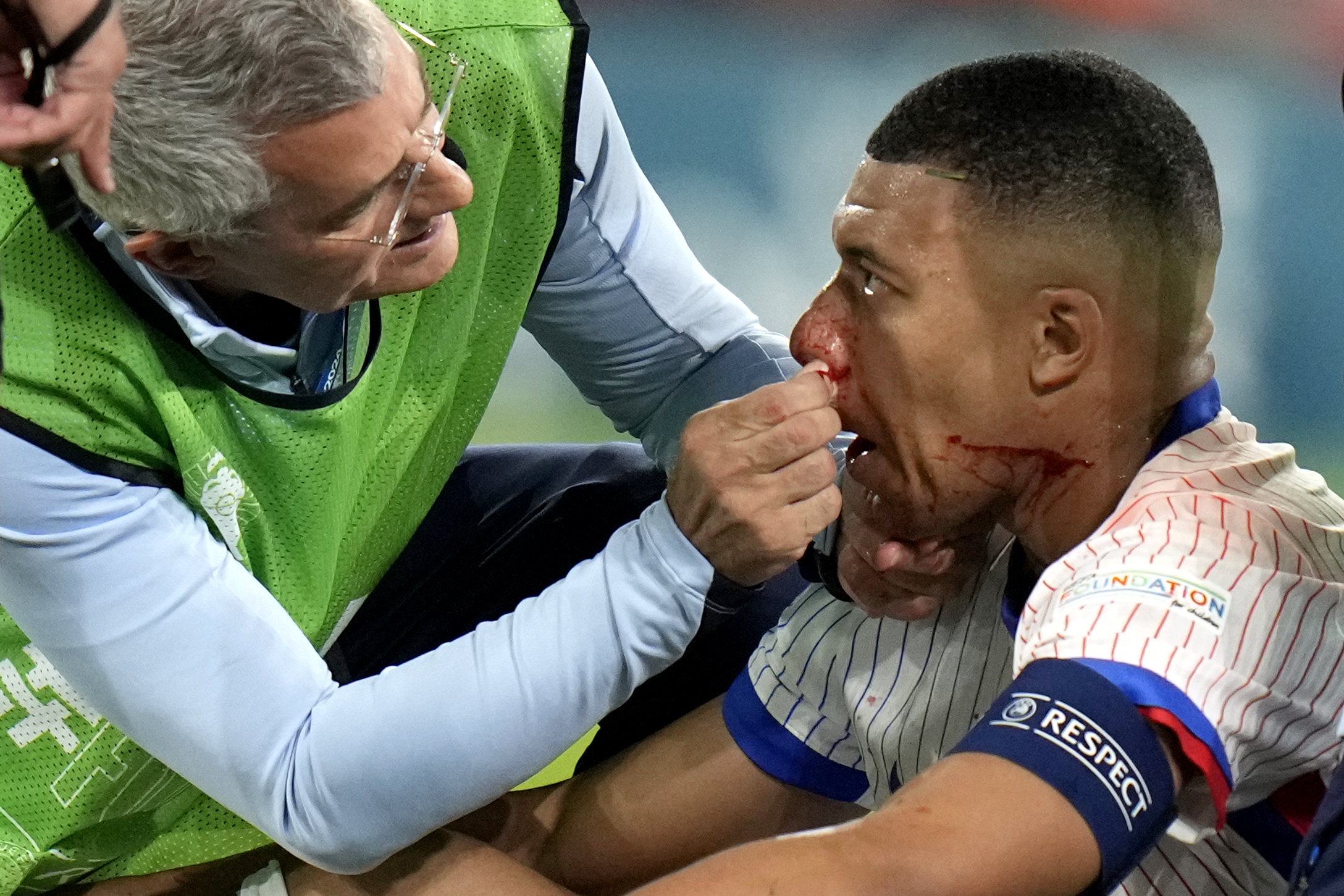 Kylian Mbappe of France receives a treatment after suffering an injury during a Group D match between Austria and France at the Euro 2024 soccer tournament in Duesseldorf, Germany, Monday, June 17, 2024. 