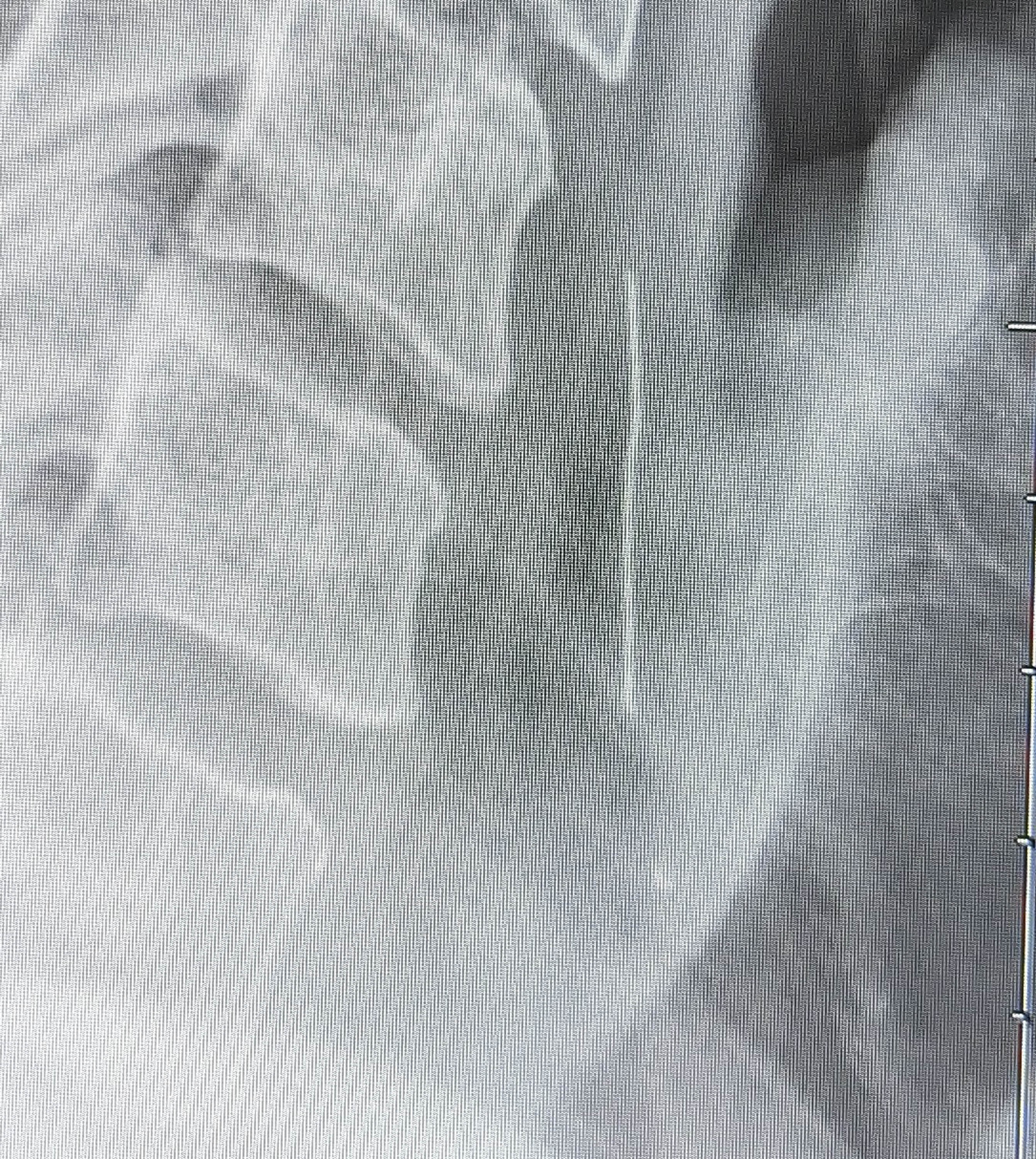 An X-ray shows a wire bristle from a grill brush inside the throat area of Peter Richards of Wrightsville, Penn.