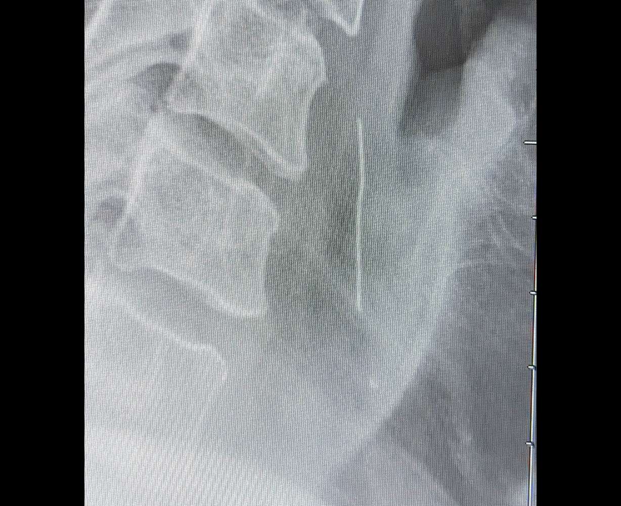 An X-ray shows a wire bristle from a grill brush inside the throat area of Peter Richards of Wrightsville, Penn.
