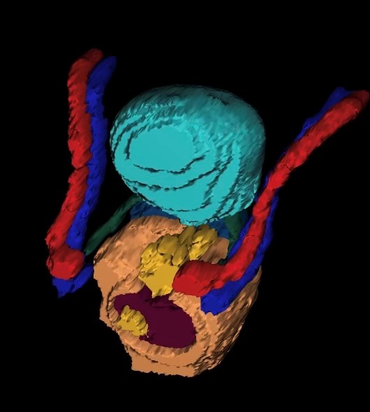 Iris software, which was introduced for colorectal cancer this year and used first on a Utah patient, shows a surgeon a 3D moveable model of a patient's MRI scan.