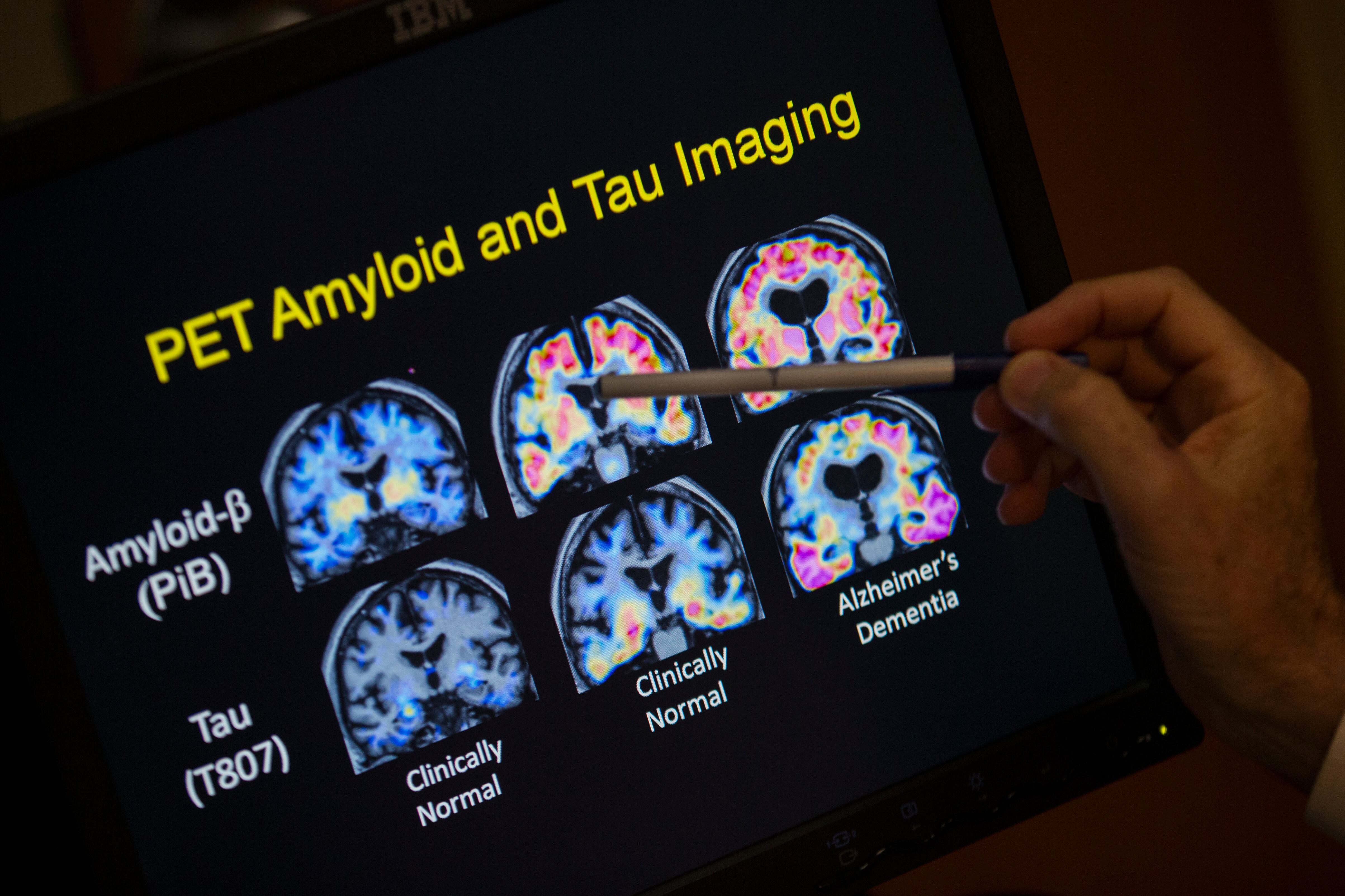 A doctor points to PET scan results that are part of a study on Alzheimer's disease at Georgetown University Hospital, on May 19, 2015, in Washington. New blood tests are showing promise for simplifying and speeding up detection of Alzheimer's.
