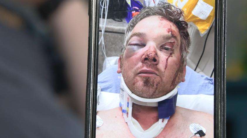 Brandon Davis suffered a broken nose and orbital in an attack after a music festival in Tooele County last weekend.