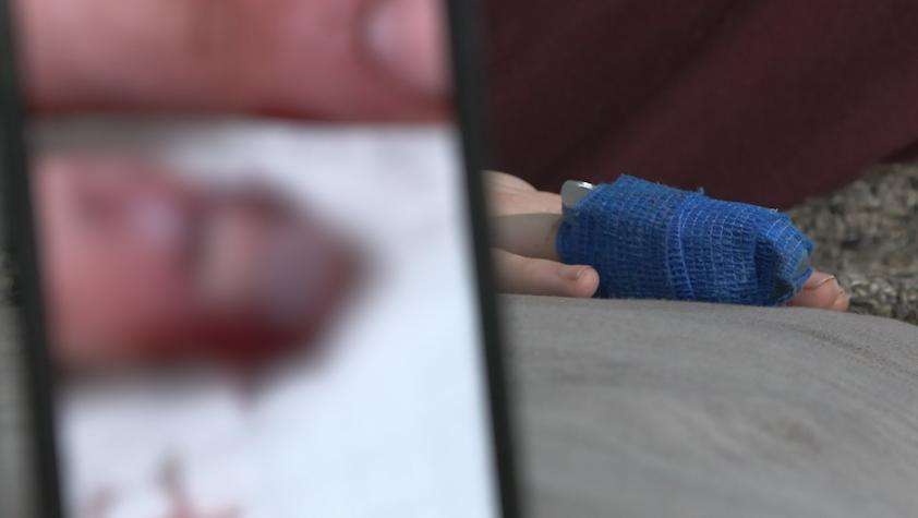 A picture shows Hayden Davis’ mangled finger, which is now bandaged. It was injured in an attack following a music festival in Tooele County last weekend.