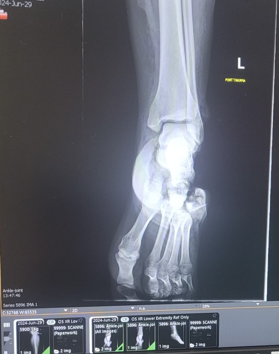 This is an x-ray of Aspen Anderson’s hurt foot.