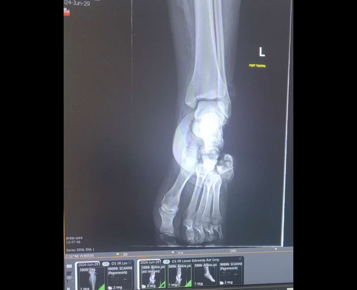 This is an x-ray of Aspen Anderson’s hurt foot.