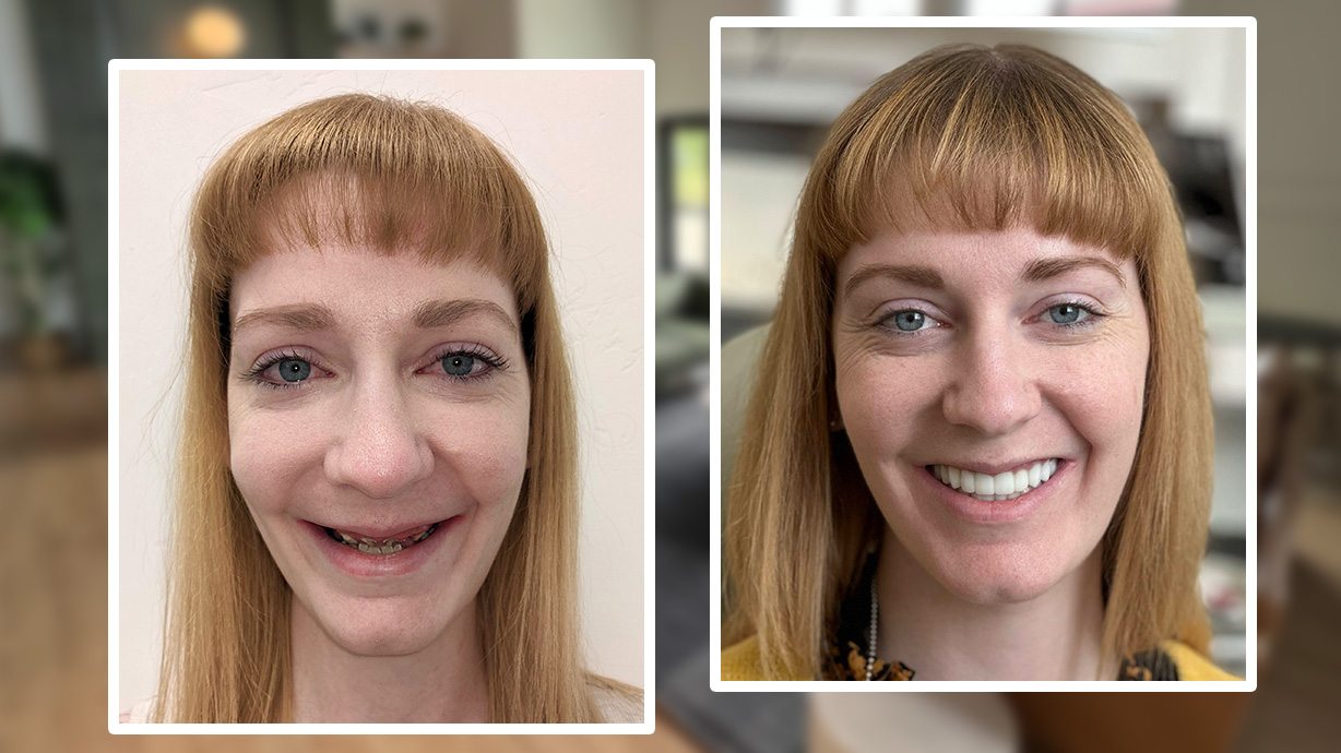 Hundreds flying to Utah for unique dental implant procedure