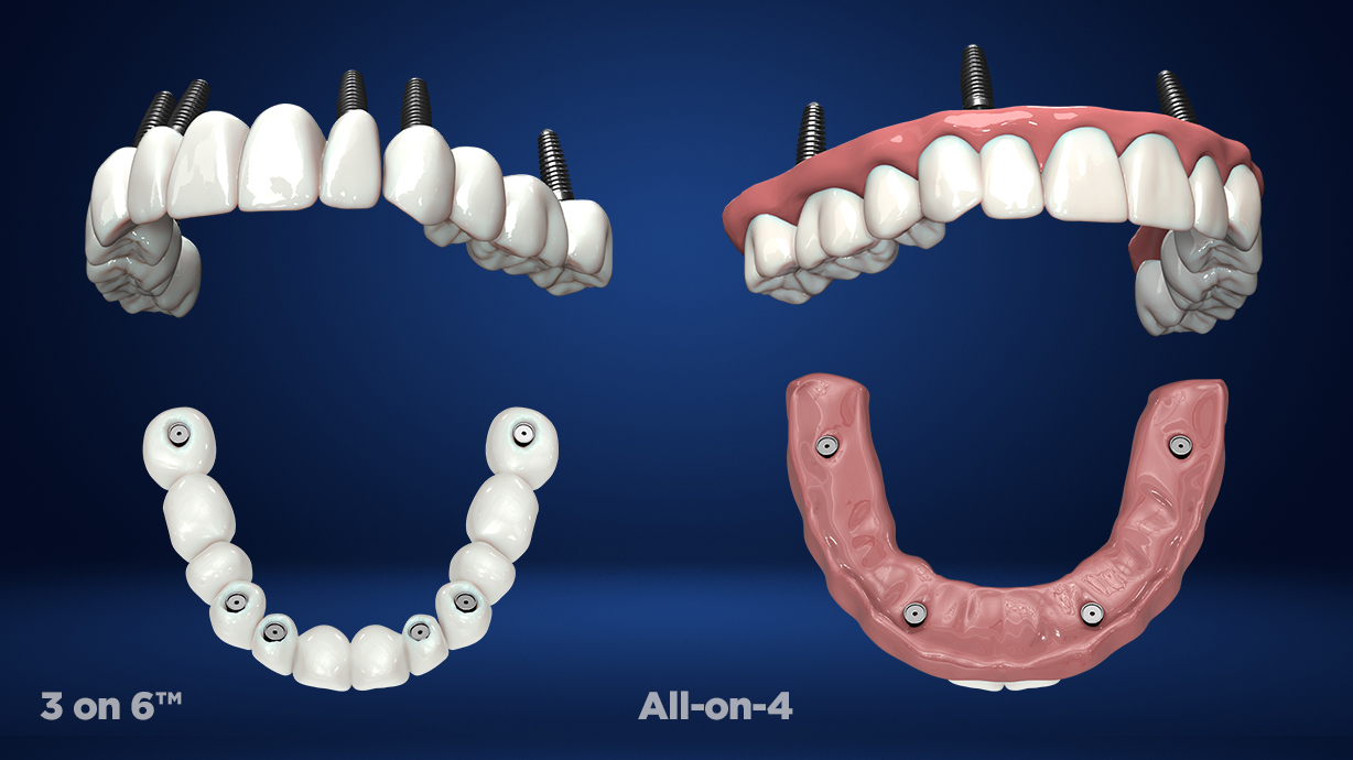 Hundreds fly to Utah for unique dental implant procedure 