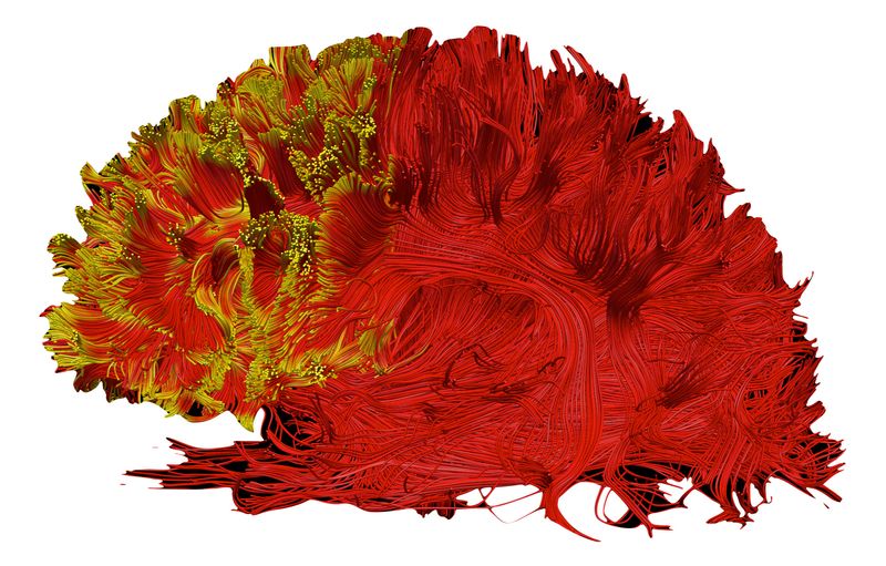 FAn illustration provides a 3D graphical representation of the altered connections, visualized with diffusion tractography (yellow tint), that are important for executive functions in people with ADHD.