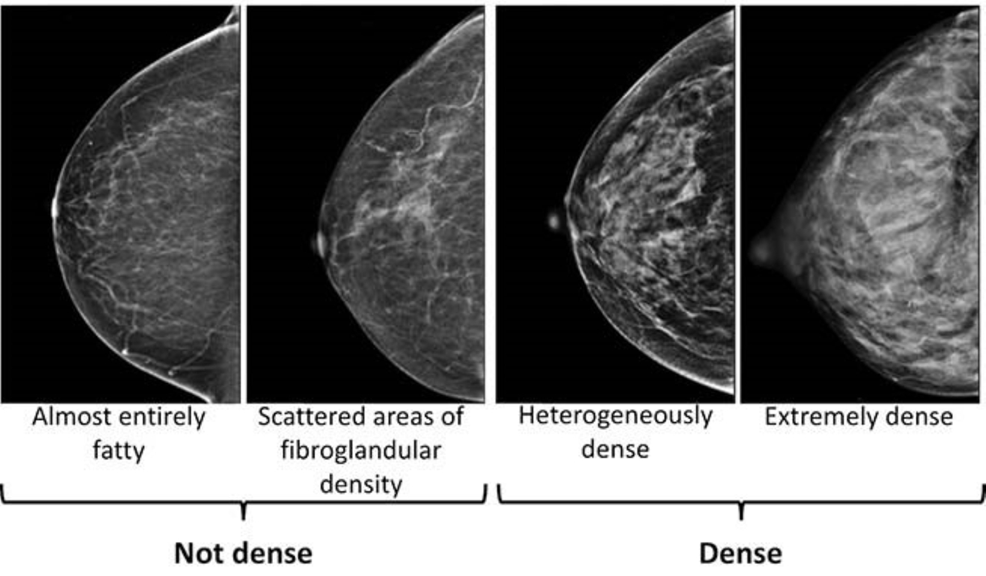 This image provided by the UW/Fred Hutch Cancer Center Breast Imaging in October 2024 shows mammogram scans with dense and not dense tissue. 