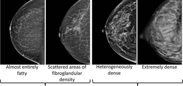 Dense breasts can make it harder to spot cancer on a mammogram