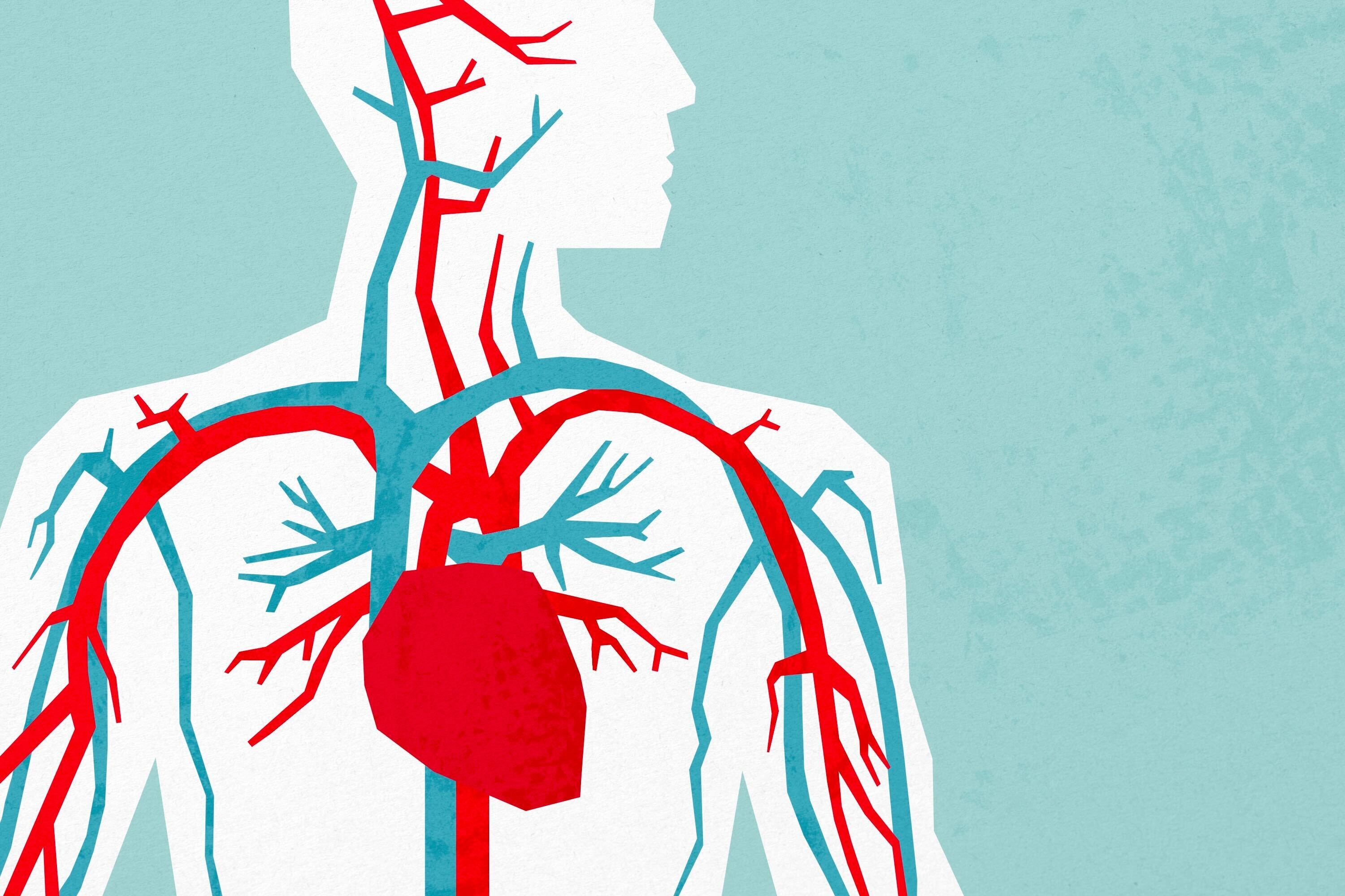 Intermountain Medical Center in Murray has become the first U.S. hospital to perform a minimally invasive surgery outside of clinical trials to treat aortic aneurysm using a new FDA-approved device.