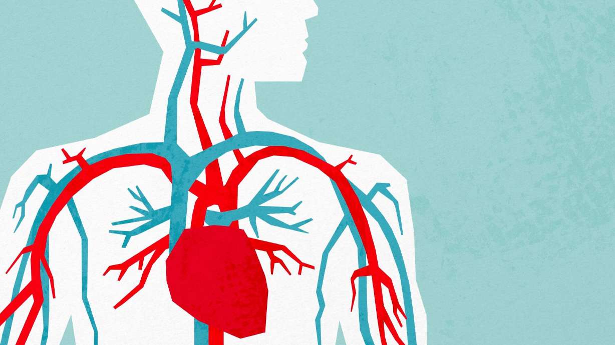 Intermountain Medical Center in Murray has become the first U.S. hospital to perform a minimally invasive surgery outside of clinical trials to treat aortic aneurysm using a new FDA-approved device.