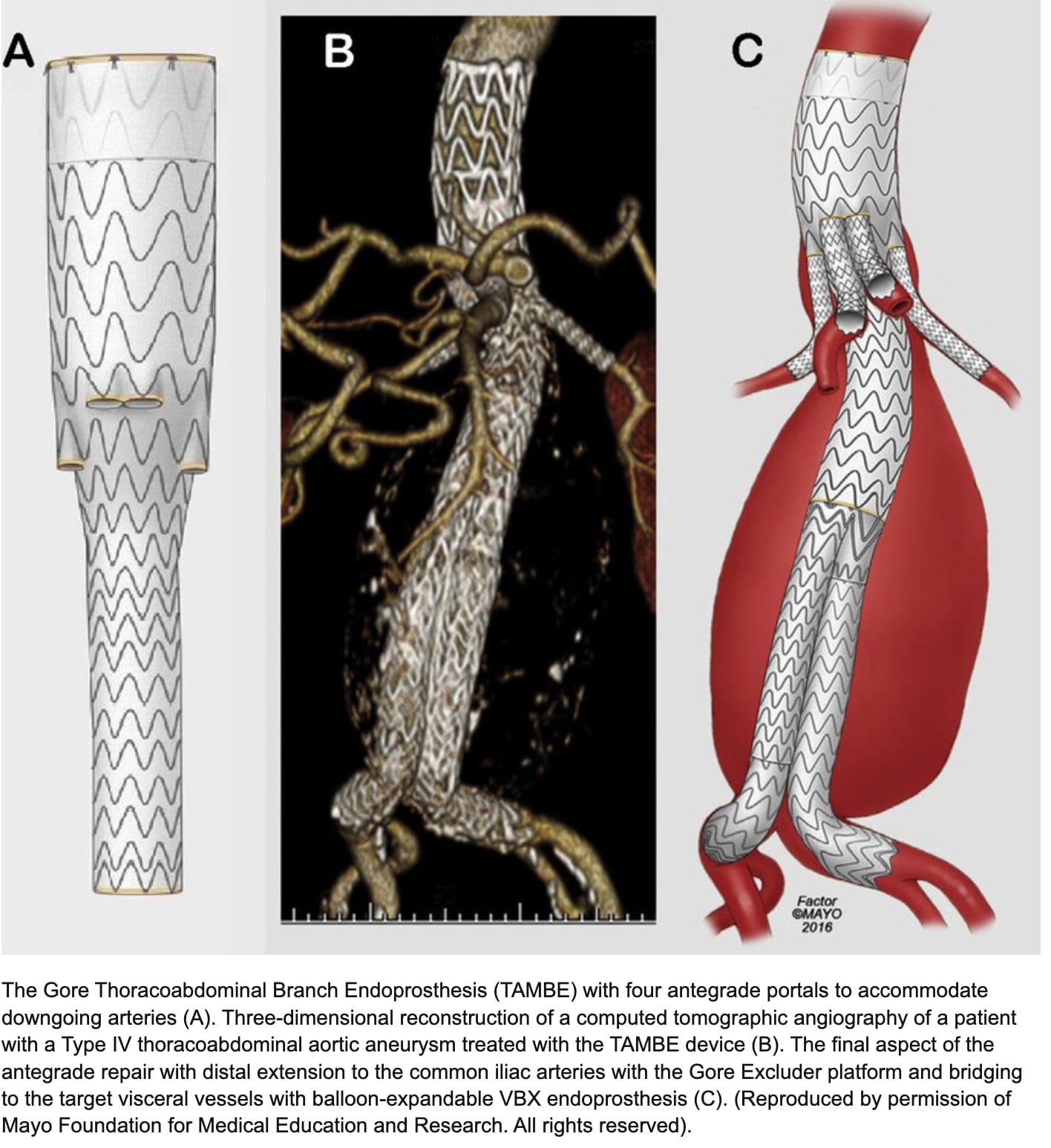 Intermountain team first to implement new aortic aneurysm treatment ...