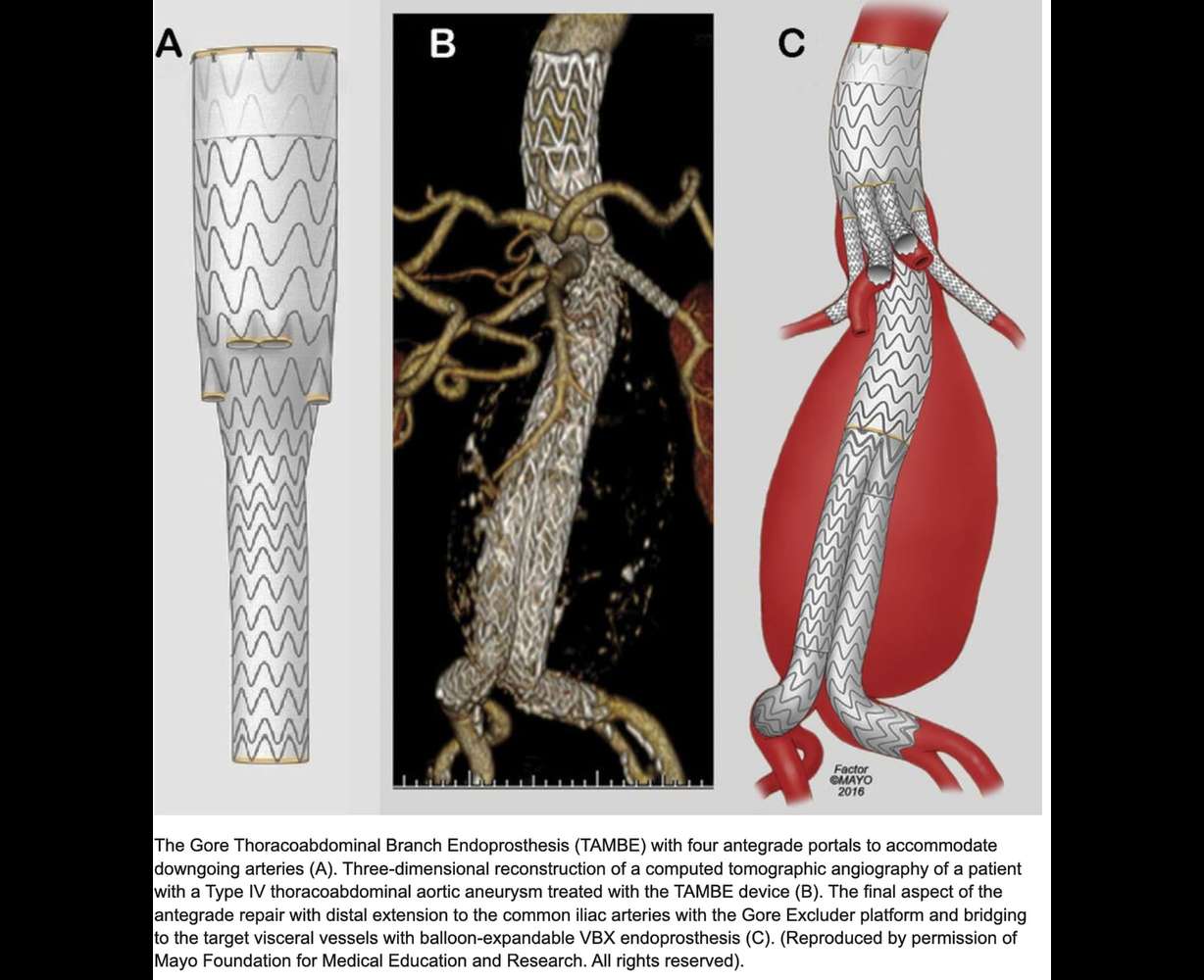 The Gore Thoracoabdominal Branch Endoprosthesis (TAMBE) with four antegrade portals to accommodate downgoing arteries (A). Three-dimensional reconstruction of a computed tomographic angiography of a patient with a Type IV thoracoabdominal aortic aneurysm treated with the TAMBE device (B). The final aspect of the antegrade repair with distal extension to the common iliac arteries with the Gore Excluder platform and bridging to the target visceral vessels with balloon-expandable VBX endoprosthesis (C).