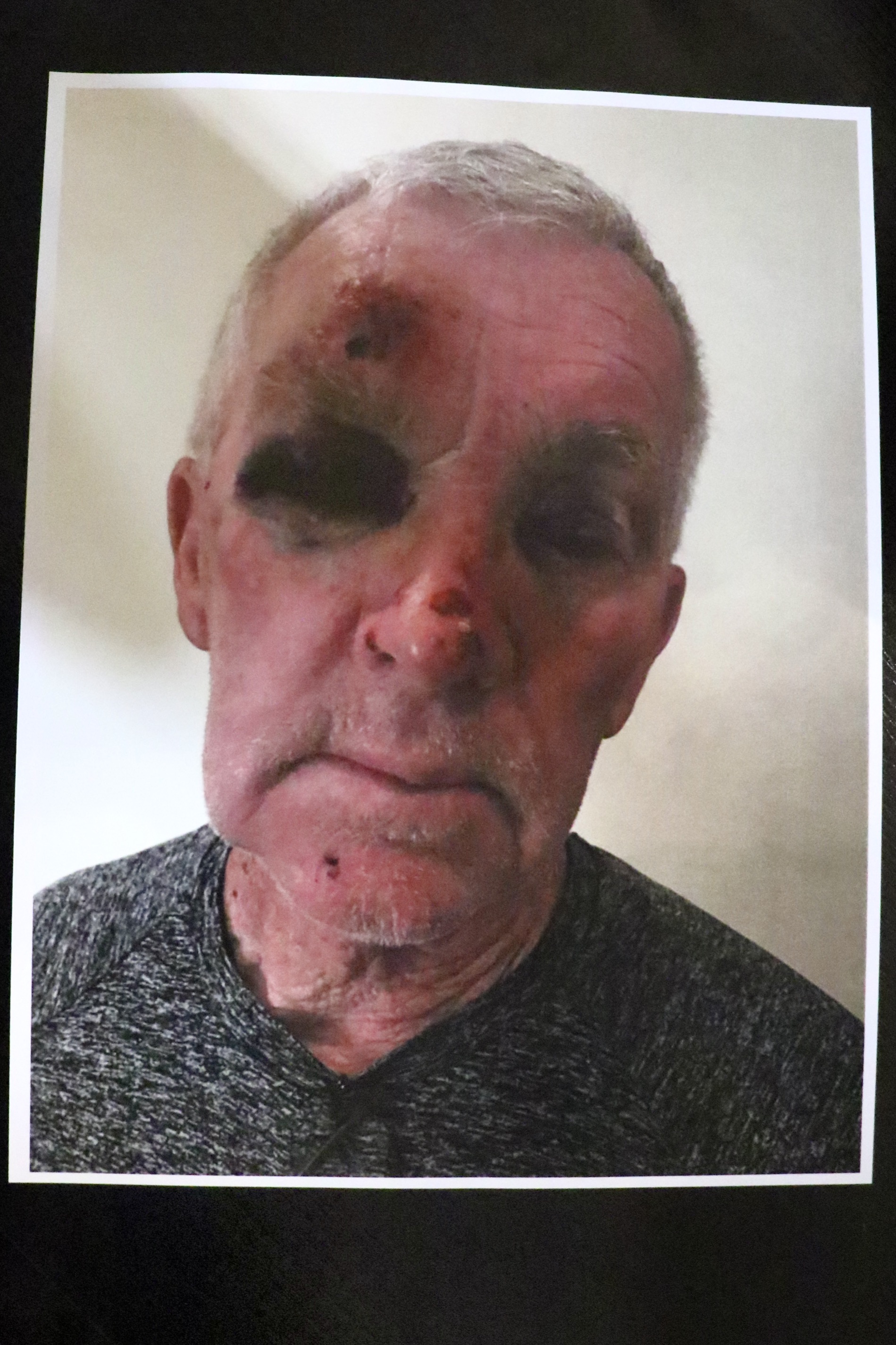 An undated photo of the injuries 74-year-old Rick Schulze sustained after Mantua Police Chief Dakota Midkiff arrested him Oct. 5.