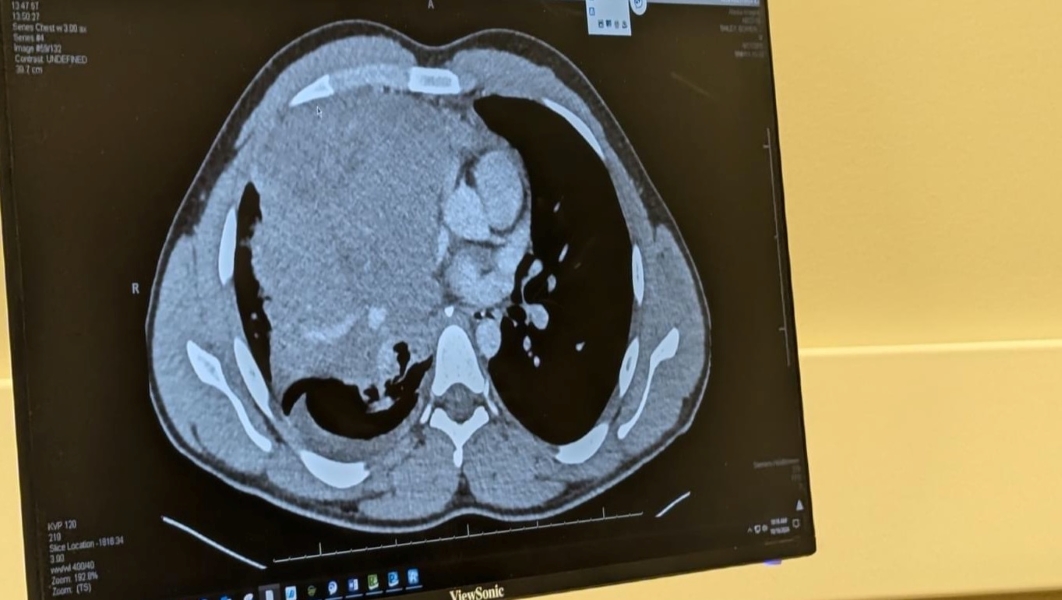 A CT scan reveals the massive tumor pushing against Bowen’s lung and heart.