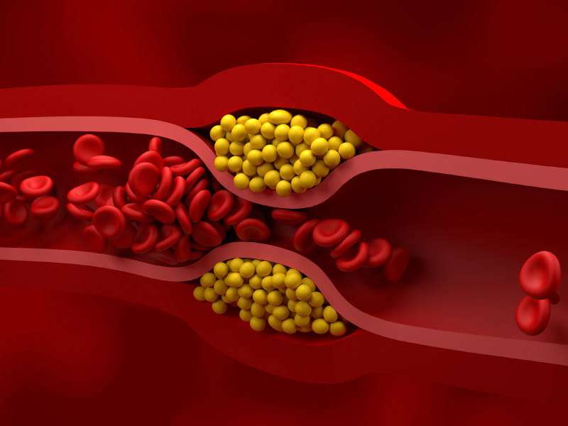 Low-density lipoprotein (LDL), or "bad," cholesterol builds up in the inner walls of the arteries, reducing blood flow. Scientists, however, believe they may have a one-time solution to correct high cholesterol through gene editing.
