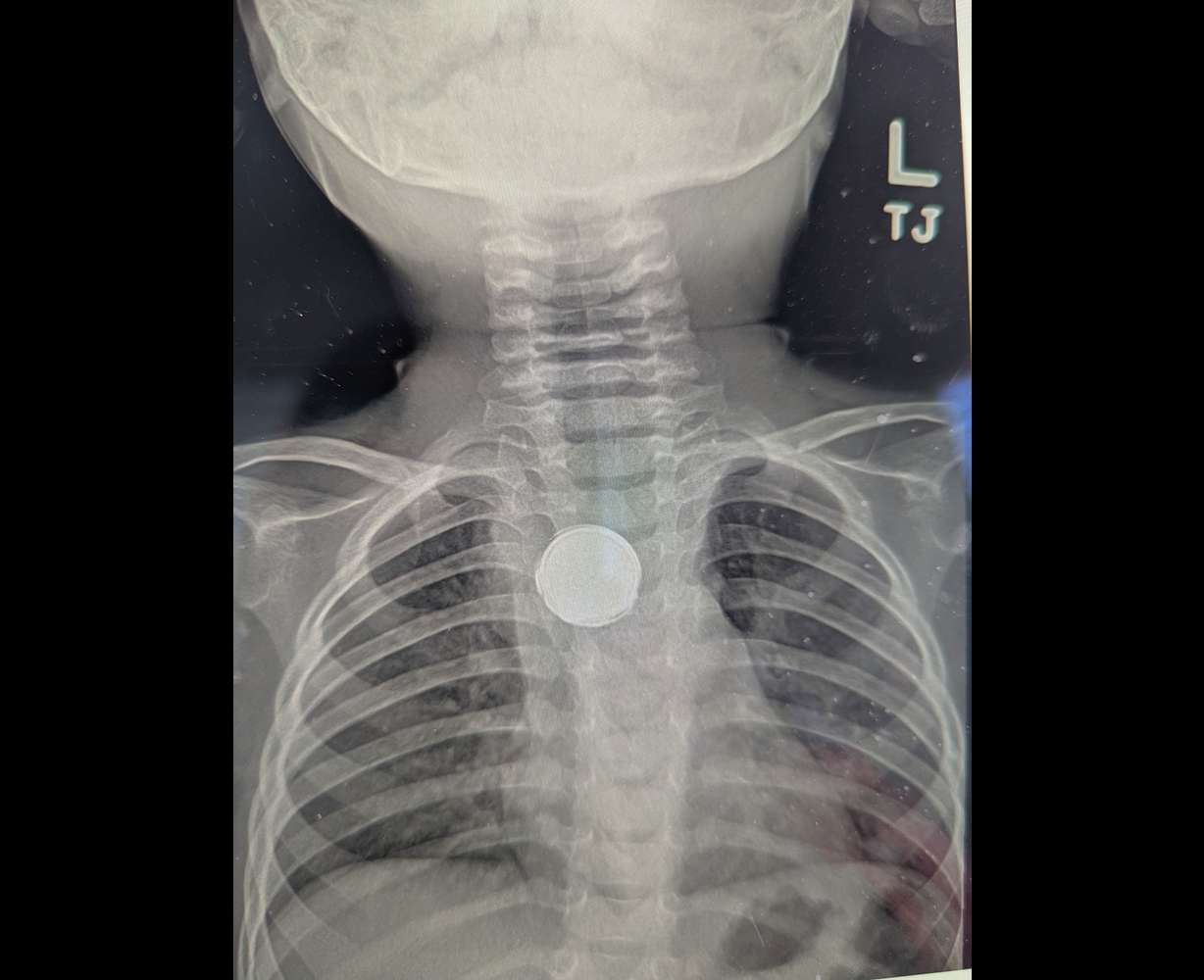 An X-ray of Luke's chest where the button battery is clearly seen. If it stayed as is, the consequences could have been fatal.