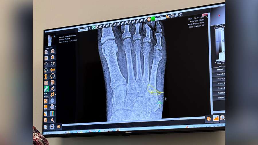 An X-ray of Lexie Littledike’s foot on the day of her fall.