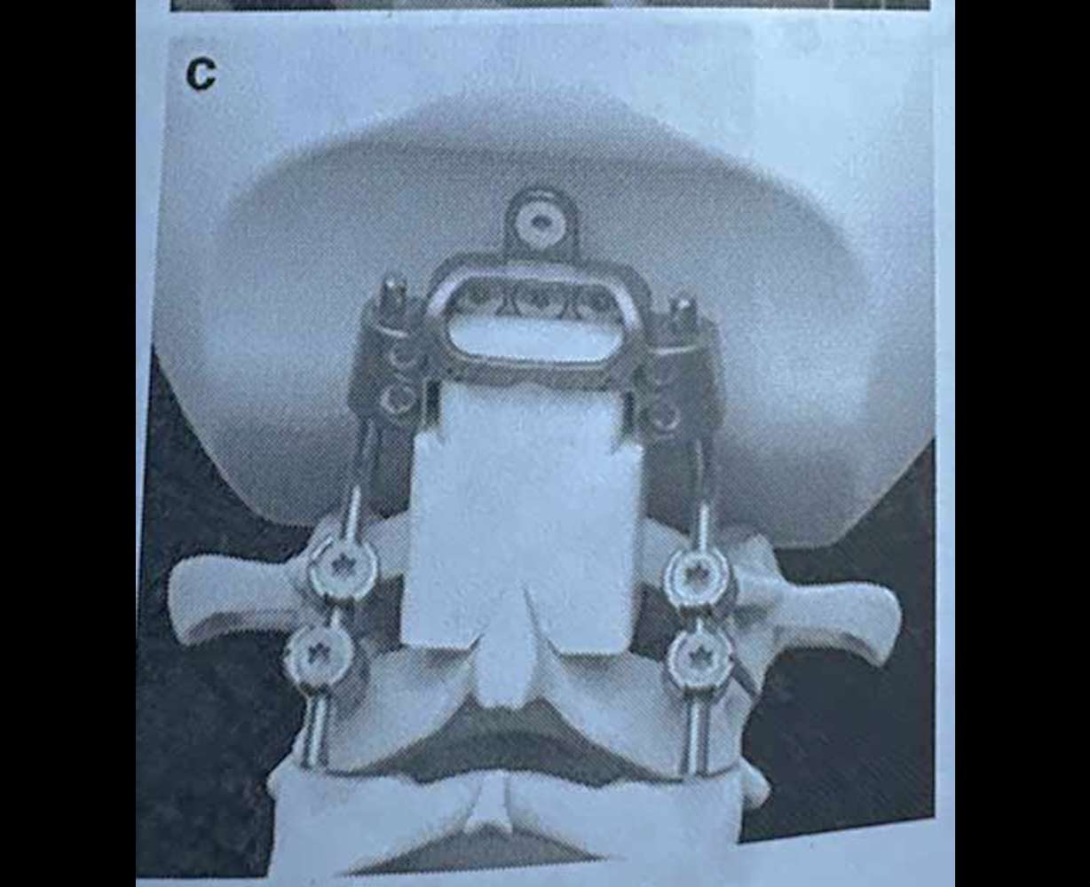 This is the device doctors will put in Farmer’s neck during surgery.