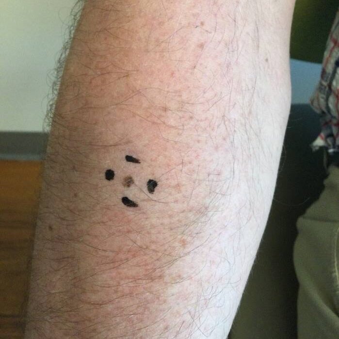 Mole on Jakob Jensen’s arm that turned out to be cancer.