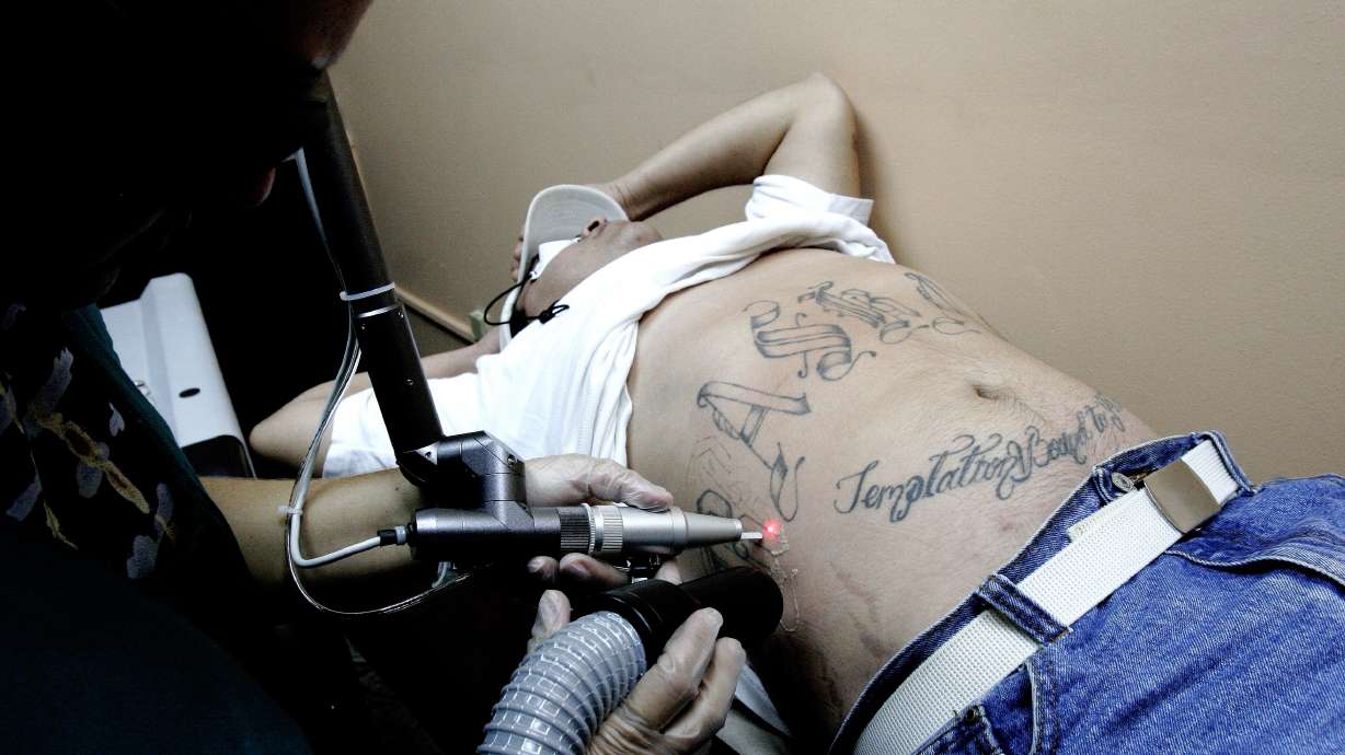FILE - A doctor, using a laser, removes tattoos from an ex-gang member deported from Los Angeles at a clinic in San Salvador, Wednesday, June 6, 2007.