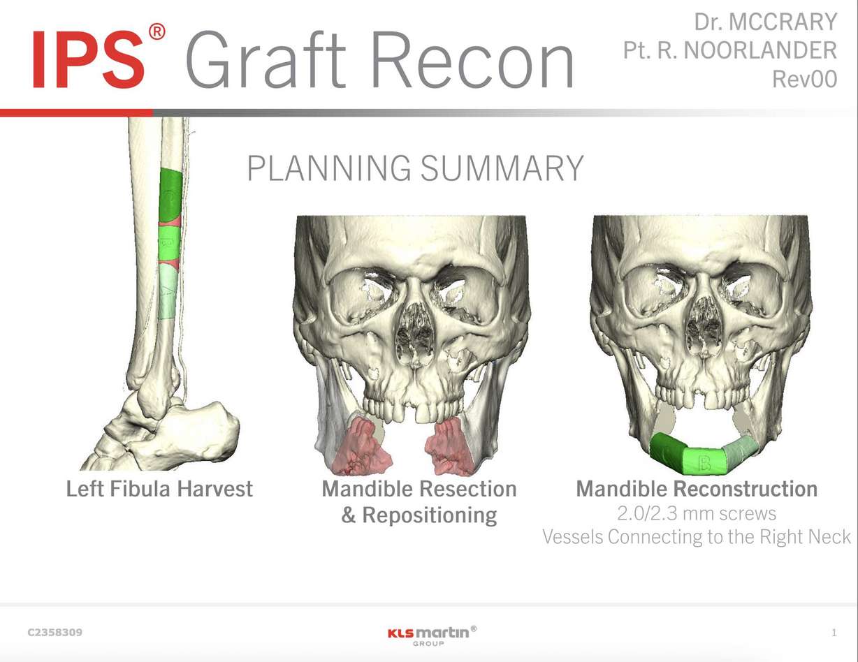 A digital rendering of Noorlander's "jaw in a day" reconstruction surgery plan. Noorlander is the survivor of a bear attack and the first recipient of this surgery at the University of Utah Hospital.