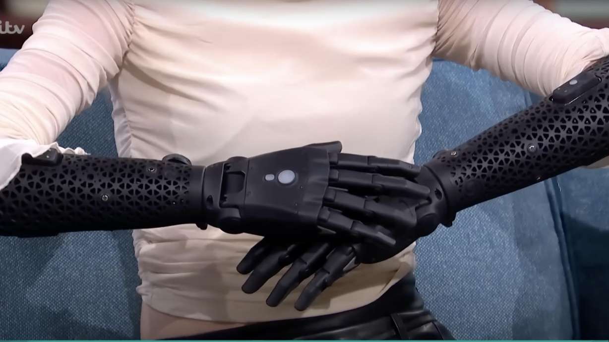 Bionic Prosthetics Prototypes Have You Seen This? 'Bionic' woman shows off the latest technology in ...