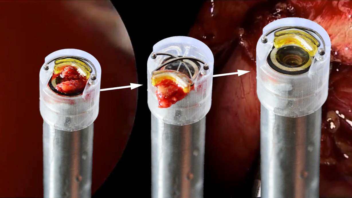 LaparoVision, a device that acts as a mini windshield wiper, helps doctors clean laparoscopes while examining inside the body.