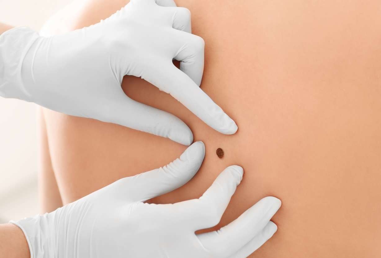 Intermountain Health launches groundbreaking treatment for advanced melanoma skin cancer