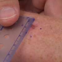 How to reduce your risk of melanoma and other skin cancers