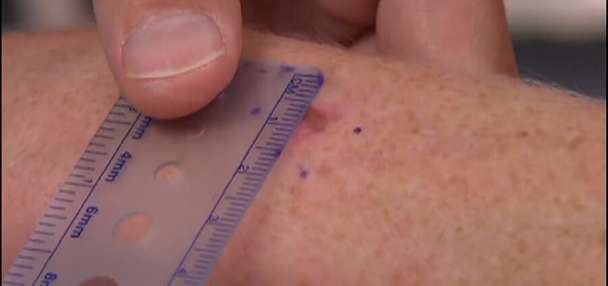 How to reduce your risk of melanoma and other skin cancers