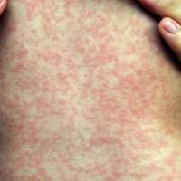 Health officials confirm first measles case in Grand County