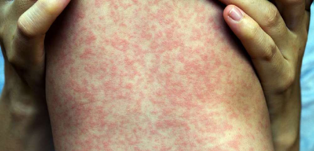Multiple people at state wrestling tournament diagnosed with measles as it spreads in Utah