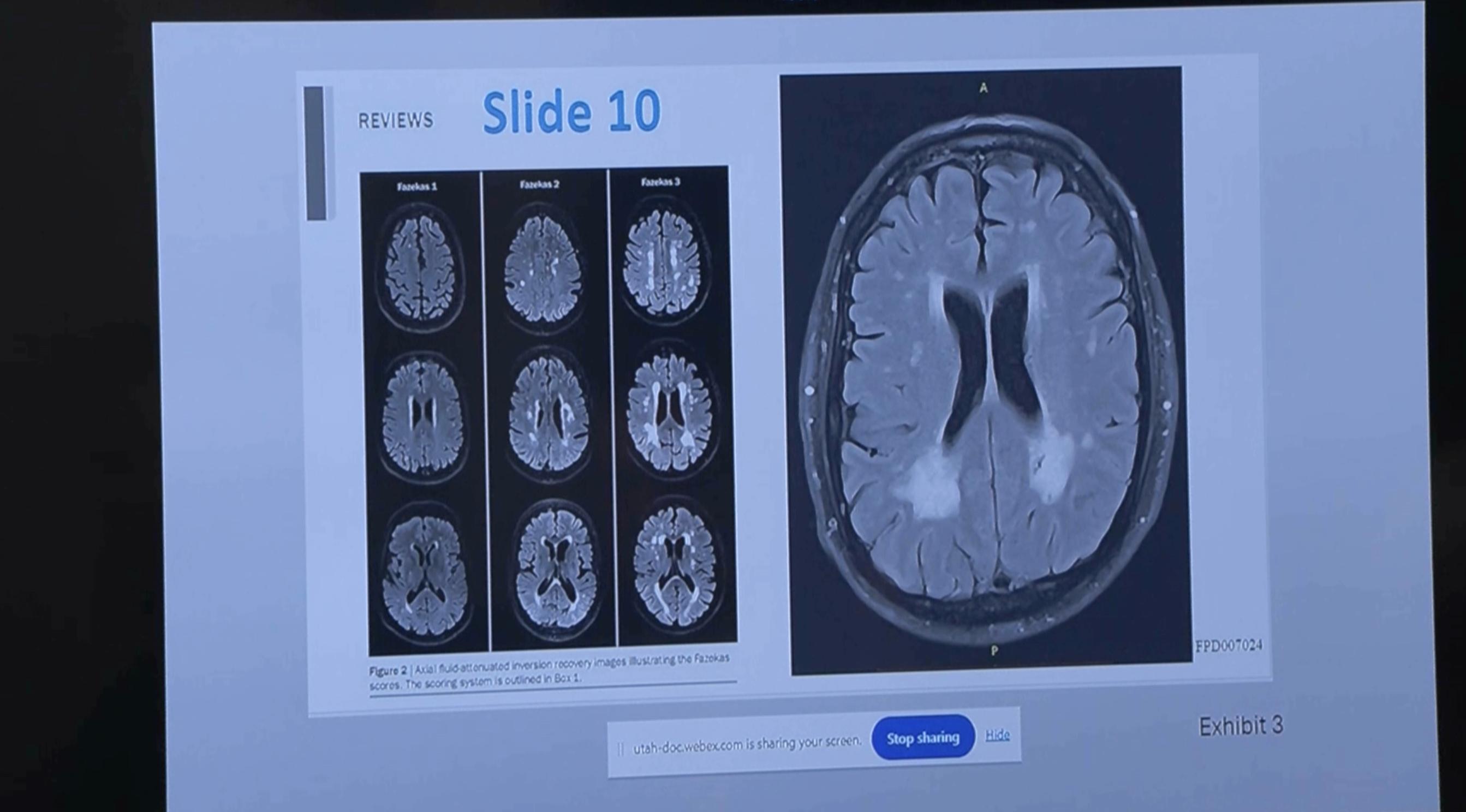 Images of death row inmate Ralph Menzies' brain are shown during a commutation hearing for the convicted murderer at the Utah State Prison on Wednesday.