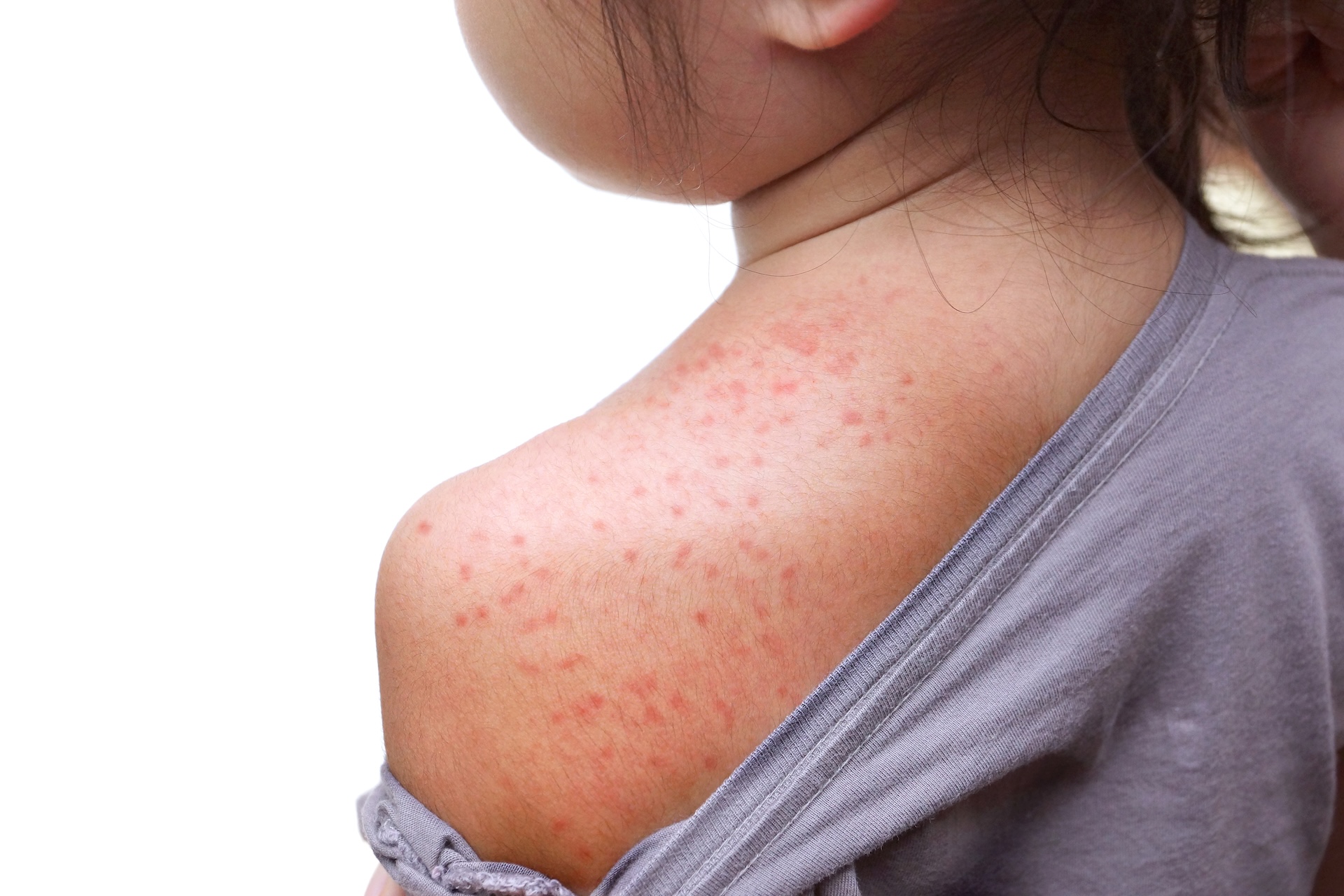 2 school-aged children in Washington County test positive for measles