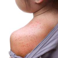 2 school-aged children in Washington County test positive for measles