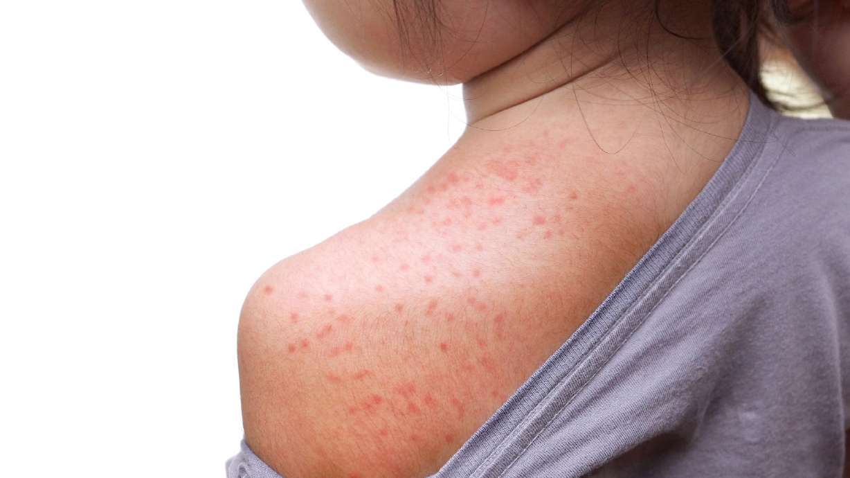 2 school-aged children in Washington County test positive for measles - KSL.com