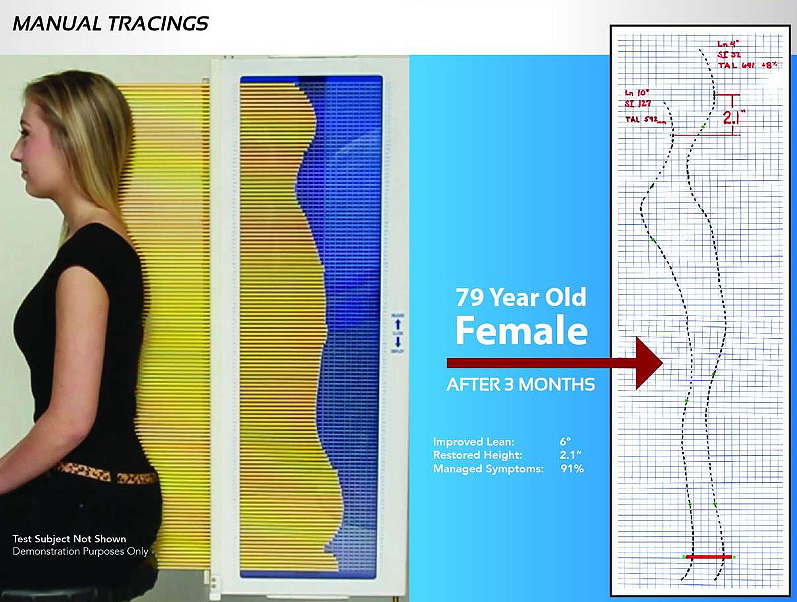 Utah woman overcomes back pain and regains 2 inches in height — without surgery