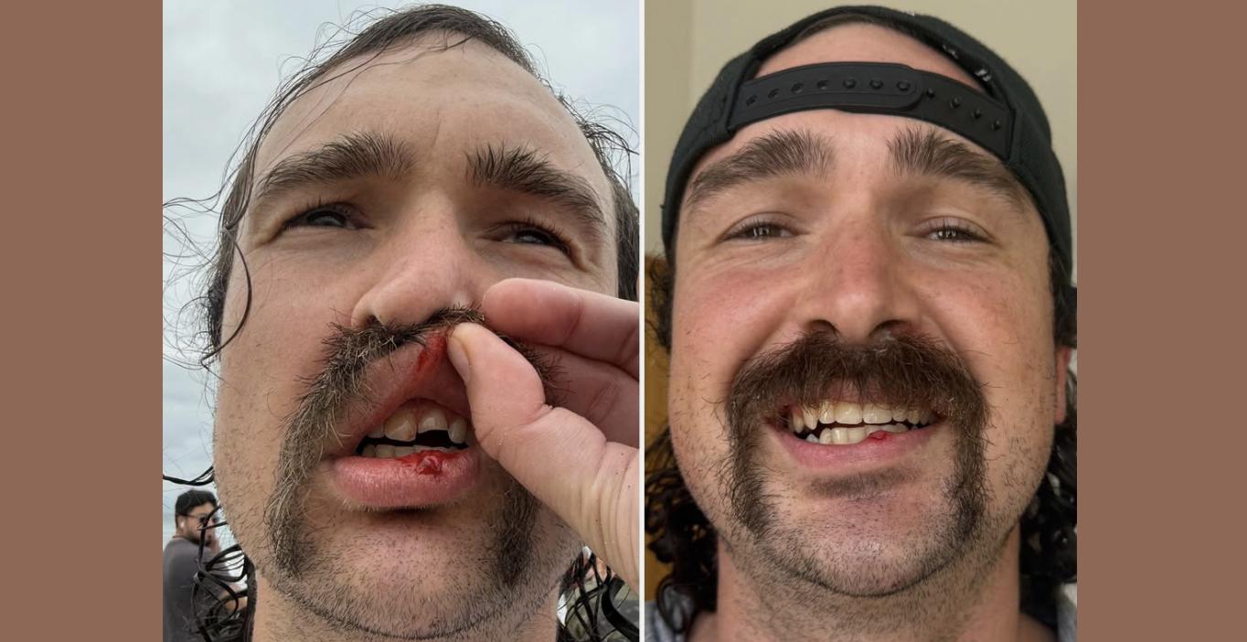 A Marine veteran who broke his tooth while surfing has a reason to smile today after a Huntington Beach dentist stepped in to help.
